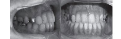 顎矯正手術後の口腔内所見写真