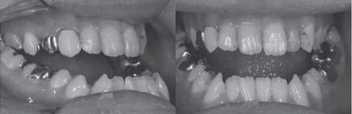 顎矯正手術前の口腔内所見写真