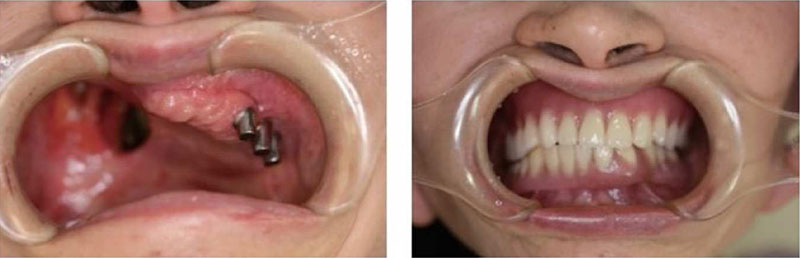 インプラントを併用した義歯治療の口腔内写真