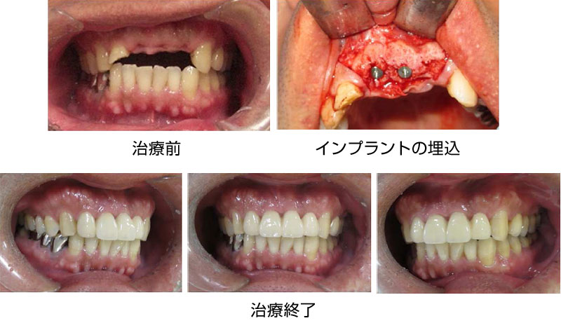 インプラントを併用した義歯治療の口腔内写真